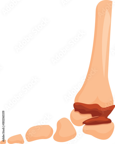 Medical illustration showing ankle pain and inflammation
