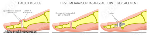 Hallux rigidus traetment. First metatarsophalangeal joint replacement