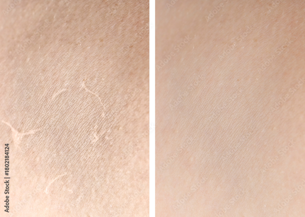 Fototapeta premium Dry skin before and after moisturizing, marco view. Collage for comparison