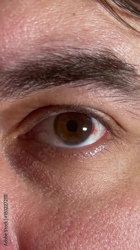 Vertical video close up. White man blinks, looks at camera. Open male eye with burst capillaries, redness, blood near brown iris. Concept of vision disease, lack of sleep, pain, stress, allergy, virus