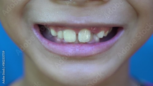 A child smiles showing off his ugly teeth and black teeth.