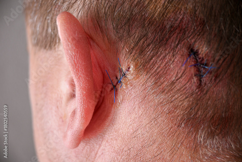 Quadro su tela Man's scalp exhibiting surgical sutures closing skin wound from injury