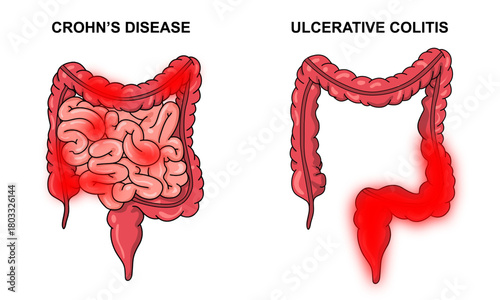 Illustration of Crohn's disease and ulcerative colitis.  inflammatory bowel disease, Inflammation of the human digestive system. Vector illustration for medical, science, and educational posters.
