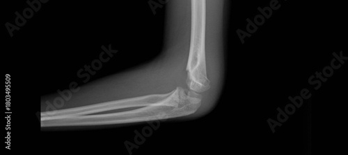 Photography Pediatric elbow x-ray showing supracondylar fracture of distal humerus