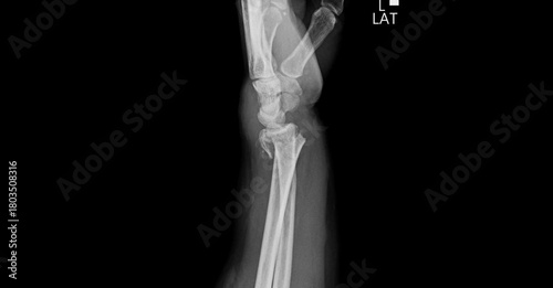 Wrist x-ray showing radius, ulna and carpal bones. Lateral view plain film radiograph for diagnostic examination of wrist anatomy and alignment structure