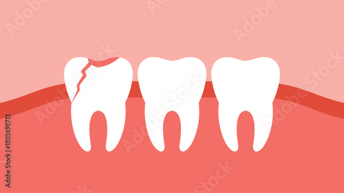 Tooth decay illustration dental problem concept vector flat design for healthcare and dentistry isolated on pink background