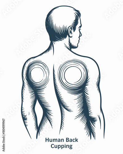 Cupping Therapy Body Healing Back Pain Relief