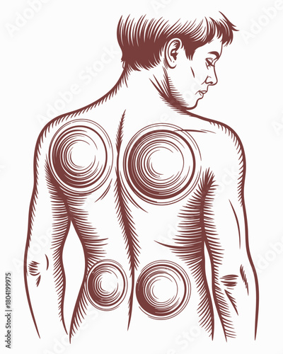 Cupping Therapy Body Healing Back Pain Relief