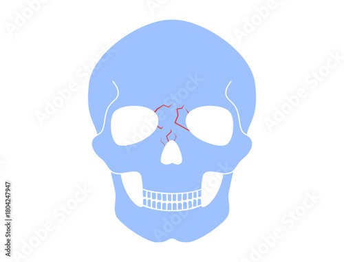 Nasal fracture poster