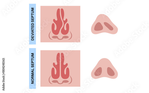 Deviated septum poster