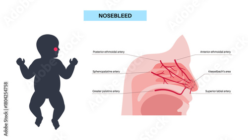 Nosebleed medical poster