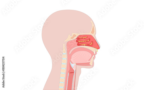 Allergic rhinitis poster