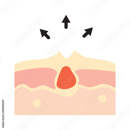 Pimple Removal Illustration