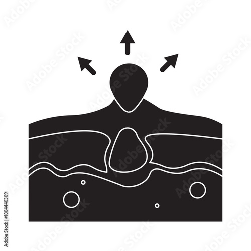 Pimple Removal Illustration