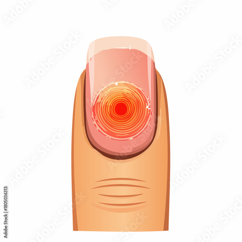 A small, healing circular burn on a finger pad, showing redness and slightly blistered, peeling edges.