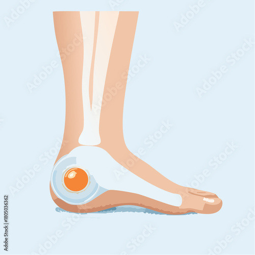 A deep, localized blister forming on the heel from friction, filled with clear fluid and unbroken.