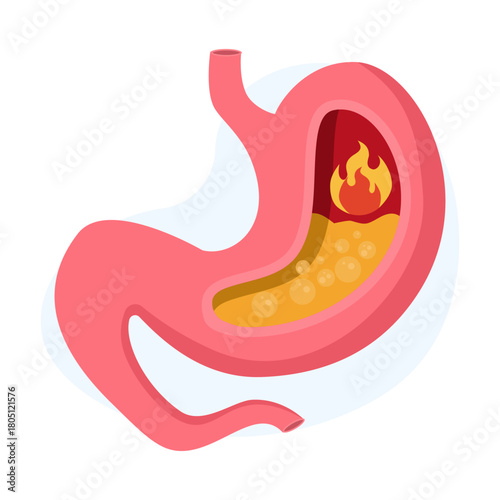 Stomach acid rising and heartburn concept, showing a stomach organ with flames, symbolizing GERD, digestive discomfort, and health issues in a minimalist graphic style.