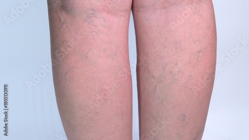 Varicose veins on the legs close up on a white background