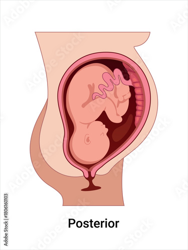 Posterior Baby Positions in the Uterus during Pregnancy. Pathology. Detailed Medical vector illustration. 
