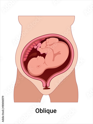 Oblique Baby Positions in the Uterus during Pregnancy. Pathology. Detailed Medical vector illustration. 
