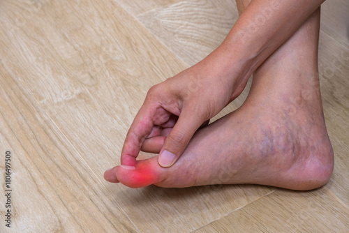 Close-up of injured big toe with redness and swelling—ideal for ads on wound care, pain relief, or first aid treatment. Copy space for your project.