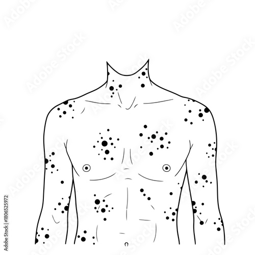 Illustration of a mans torso with spots, isolated on, showcasing skin condition and health concerns in a simple design