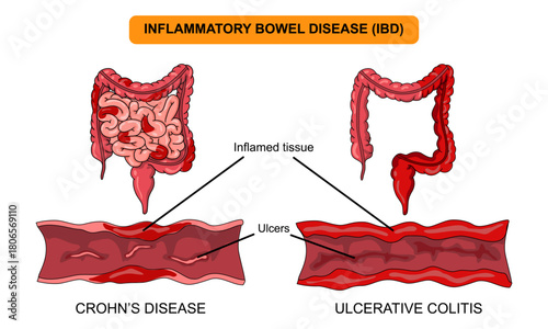 Illustration of inflammatory bowel disease. Crohn's disease and ulcerative colitis. Inflammation of the human digestive system. Vector illustration for medical, science, and educational posters.
