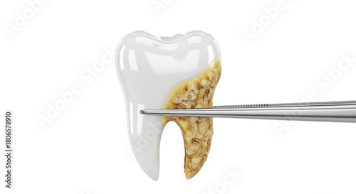 Tooth with tartar held by dental tweezers, precision oral care and dental health maintenance, isolated on white