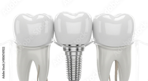 Dental implant replacing tooth, flanked by two healthy teeth. cutout on transparent background.