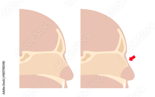 Nasal fracture poster