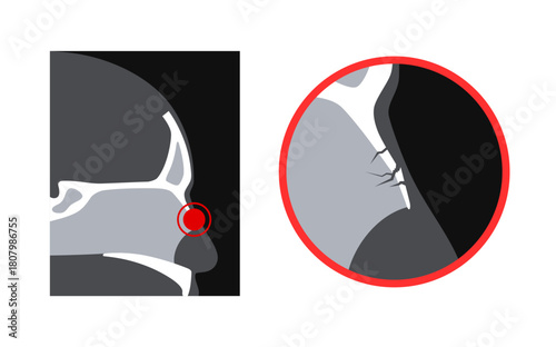 Nasal fracture poster
