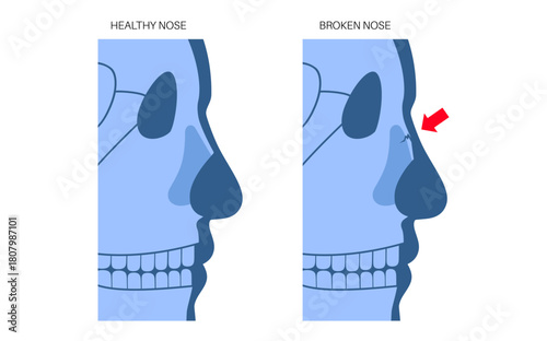 Nasal fracture poster
