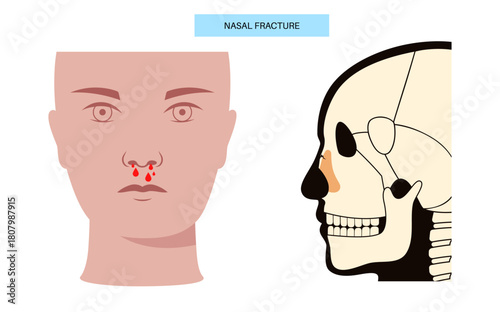 Nasal fracture poster