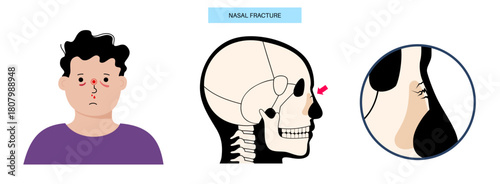 Nasal fracture poster