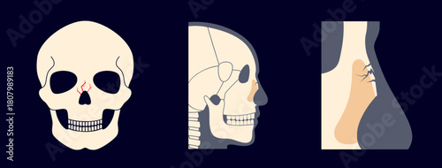 Nasal fracture poster