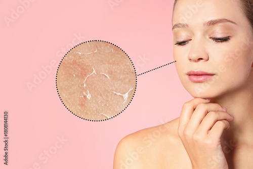 Принти на полотні Magnified area of cheek with flaky dry skin