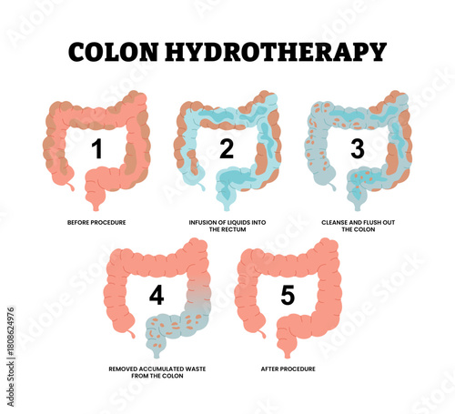 Colon hydrotherapy procedure. Before, infusion liquids into rectum, water cleanse flush out, removed accumulated waste. Large intestine colonic irrigation. Medical healthcare flat illustration.