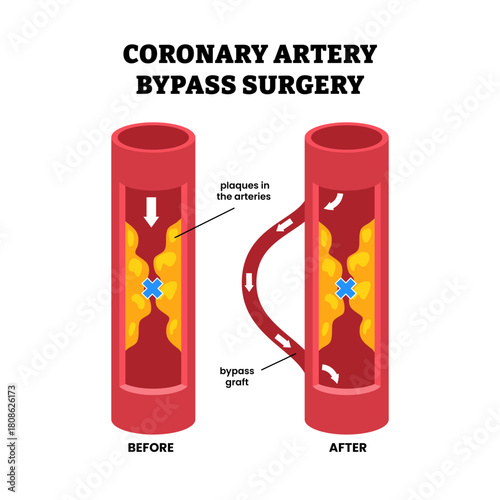 Before after Coronary artery bypass graft, heart surgery. Atherosclerosis plaques blocked in arteries. Blocked heart blood vessels or blood flow. Medical diagram. Flat vector illustration