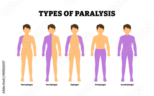 Different types of paralysis types. Labeled monoplegia, hemiplegia, diplegia, paraplegia, quadriplegia. Loss of motor function. Nervous system damage. Rehabilitation therapy. Vector illustration.