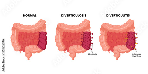 Different types of Bowel colon cancer, labeled healthy colon, diverticulosis, diverticulitis with colonoscopy. Diverticula, rectum, sigmoid colon. Colorectal colon. Medical illustration vector.
