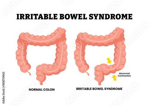 Irritable bowel syndrome. Colon disease. Abnormal contraction in large intestine. Stomach illness. Gastrointestinal disorder. Medical poster design healthcare scheme. Flat vector illustration.