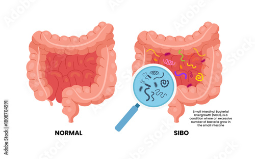 SIBO or small intestinal bacterial overgrowth. Excessive number of bacteria grow in small intestine. olon Rectal vomiting spastic mucous colitis viral acid level celiac abdomen yeast system germs.