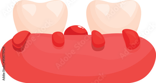 Cartoon illustration of inflamed and bleeding gums with two teeth and epulis