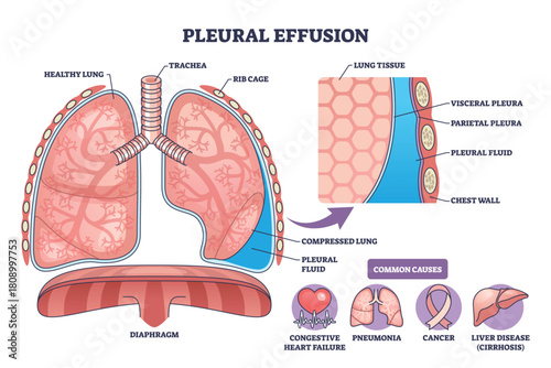 Pleural effusion diagram depicts fluid in pleural space compressing a lung, with labeled pleura layers and causes, key objects, lungs, pleural fluid, diaphragm. Outline diagram