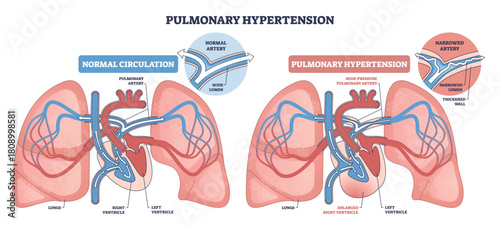 Pulmonary hypertension overview comparing normal vs high-pressure flow, featuring lungs, heart, and pulmonary artery, shows narrowed lumen and right ventricle strain. Outline diagram