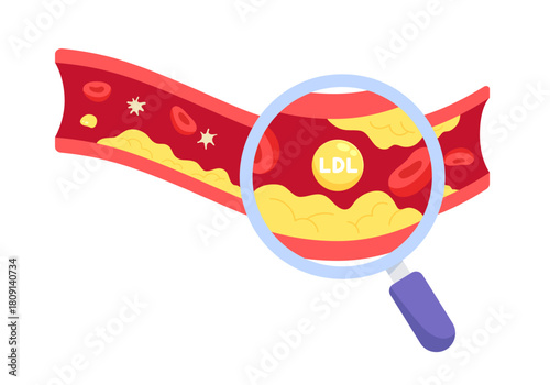 Magnifying glass is enlarging the fat accumulated in the blood vessel. Accumulation of LDL cholesterol in blood vessels. Conept of Arteriosclerosis, health checkup. Flat vector illustration.