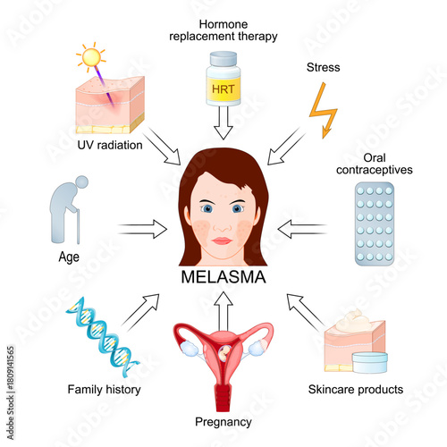 Melasma triggers. Chloasma. Skin hyperpigmentation