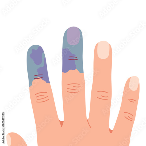 Injured fingers with frostbite showing discoloration and swelling  
