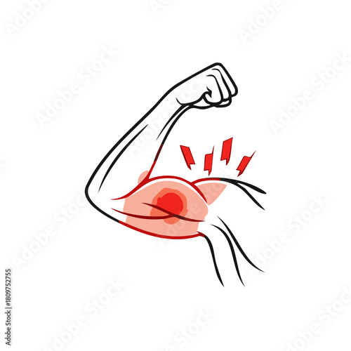Arm Pain Illustration Showing Muscle Inflammation and Potential Injury