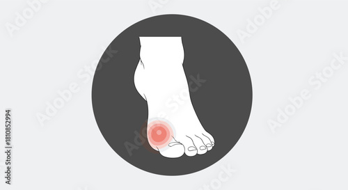 Illustration of a foot with a painful red inflamed area on the big toe joint.